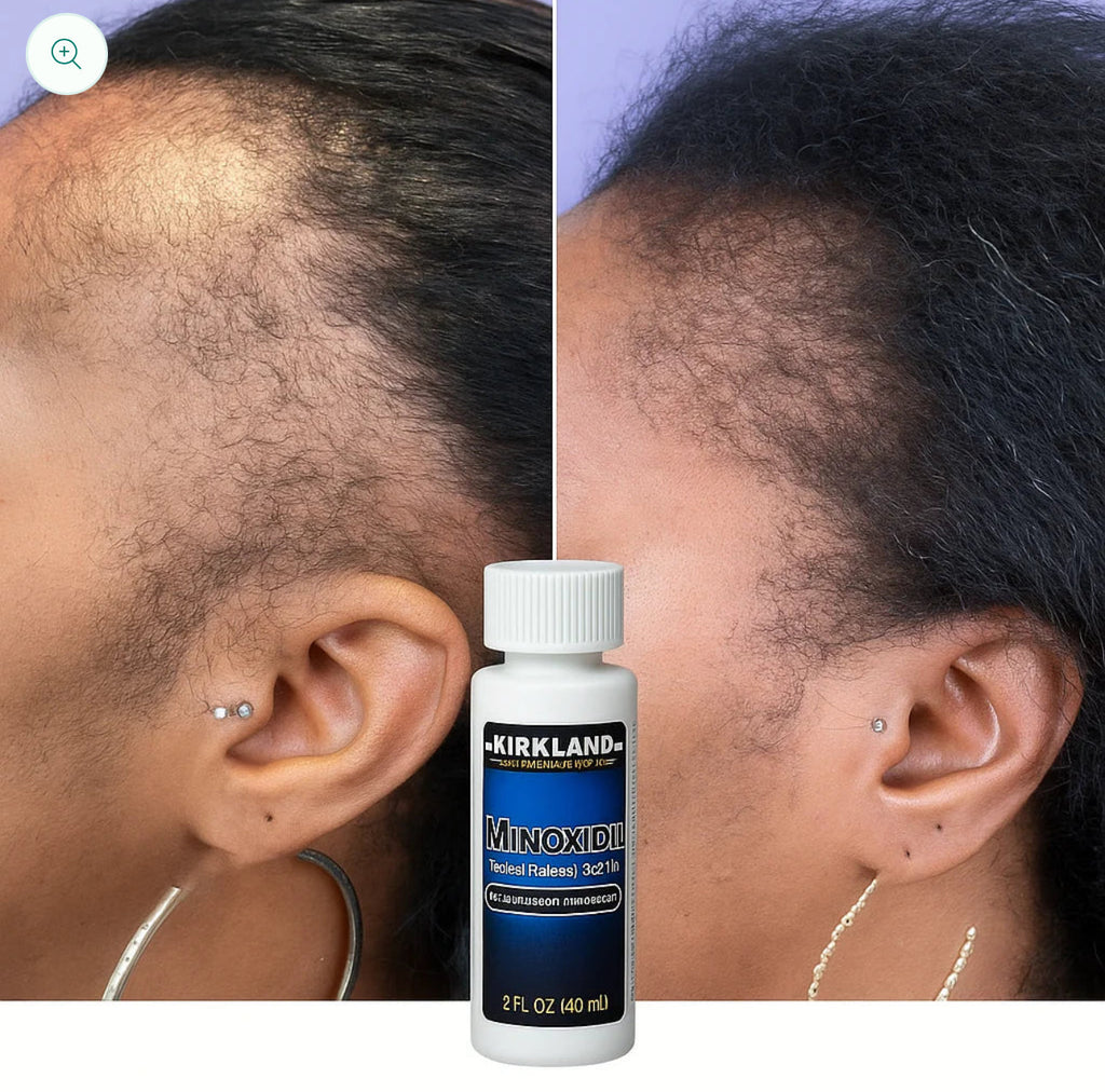 Minoxidil hair growth solution Minoxidil 5% Topical Solution Extra Strength Hair Regrowth